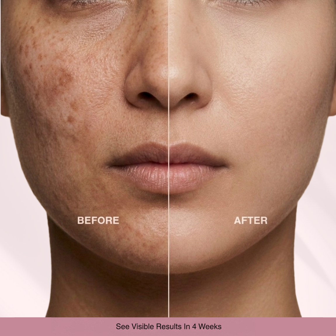 Before and after comparison of a person's face with visible skin improvement.